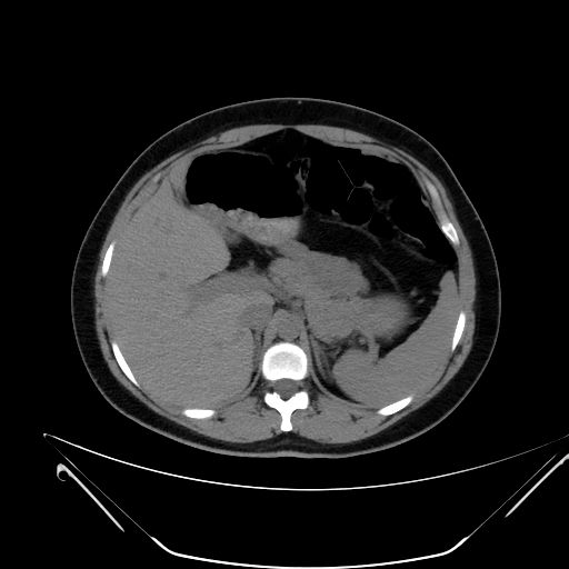 File:Bilateral ovarian mature cystic teratomas (Radiopaedia 79373-92457 Axial non-contrast 6).jpg