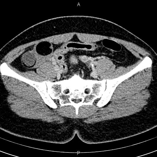 Bilateral ovarian teratoma (Radiopaedia 83131-97503 B 25).jpg