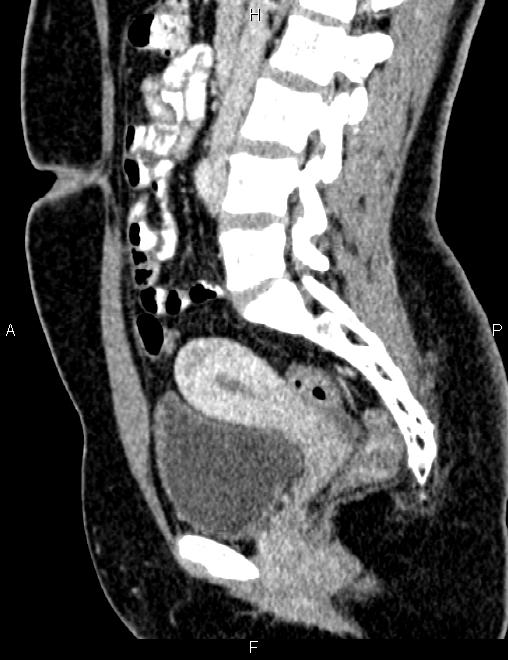 Bilateral ovarian teratoma (Radiopaedia 83131-97503 D 59).jpg