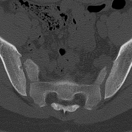 Bilateral pars defect (Radiopaedia 26691-26846 Axial bone window 104).jpg