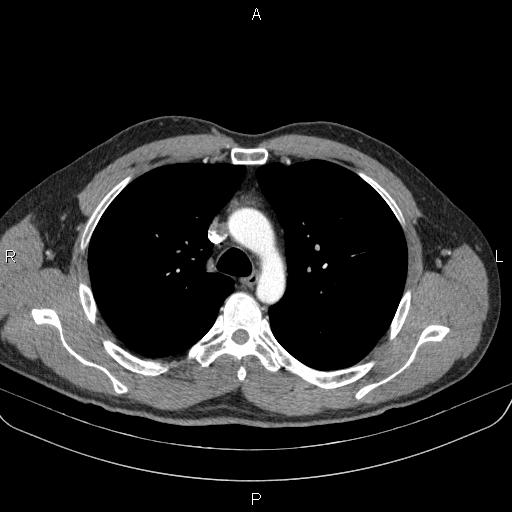 Bilateral pulmonary AVM (Radiopaedia 83134-97505 A 24).jpg