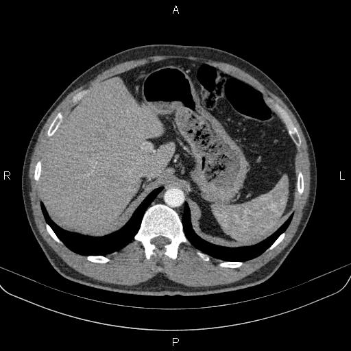 File:Bilateral pulmonary AVM (Radiopaedia 83134-97505 A 71).jpg