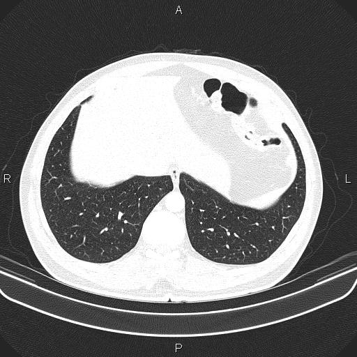 File:Bilateral pulmonary AVM (Radiopaedia 83134-97505 Axial lung window 61).jpg