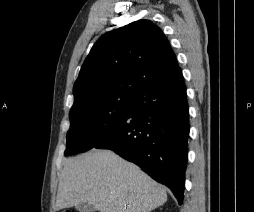 Bilateral pulmonary AVM (Radiopaedia 83134-97505 D 39).jpg