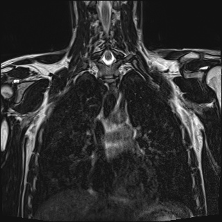 Bilateral spinoglenoid notch ganglion cysts (Radiopaedia 29577-30082 Coronal T2 64).jpg