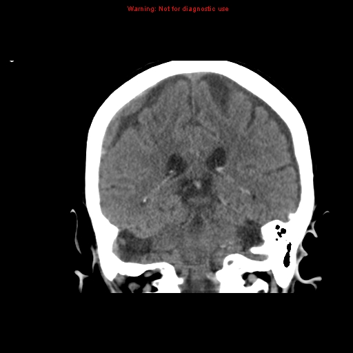 File:Bilateral subdural hemorrhage (Radiopaedia 8819-9620 Coronal non-contrast 12).jpg