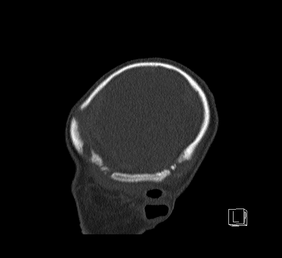 Bilateral subdural hemorrhage and parietal skull fracture (Radiopaedia 26058-26192 Sagittal bone window 10).png