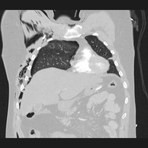 Bilateral traumatic renovascular injury (Radiopaedia 32051-32995 Coronal lung window 24).jpg