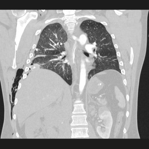 Bilateral traumatic renovascular injury (Radiopaedia 32051-32995 Coronal lung window 50).jpg