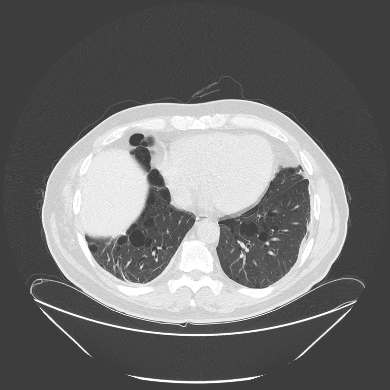Birt-Hogg-Dubé syndrome (Radiopaedia 52578-58491 Axial lung window 44).jpg
