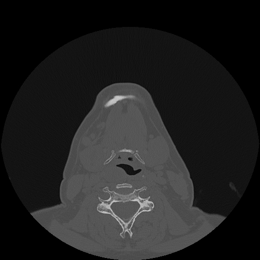 File:Bisphosphonate-related osteonecrosis of the jaw (Radiopaedia 71324-81642 Axial bone window 11).jpg