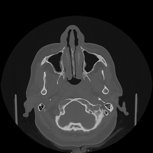 File:Bisphosphonate-related osteonecrosis of the jaw (Radiopaedia 71324-81642 Axial bone window 132).jpg