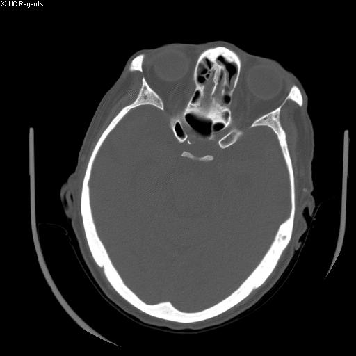 File:Bisphosphonate-related osteonecrosis of the maxilla (Radiopaedia 51367-57100 Axial bone window 21).jpg