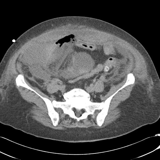 Bladder rupture post renal biopsy (Radiopaedia 30863-31572 Axial non-contrast 62).jpg