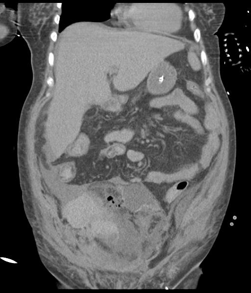 File:Bladder rupture post renal biopsy (Radiopaedia 30863-31572 Coronal non-contrast 22).jpg