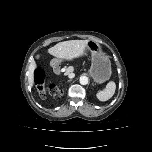 File:Bladder tumor detected on trauma CT (Radiopaedia 51809-57609 B 37).jpg