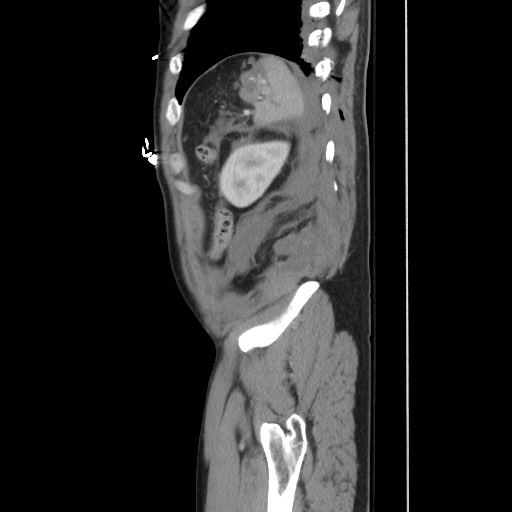 Blunt abdominal trauma with solid organ and musculoskelatal injury with active extravasation (Radiopaedia 68364-77895 C 120).jpg