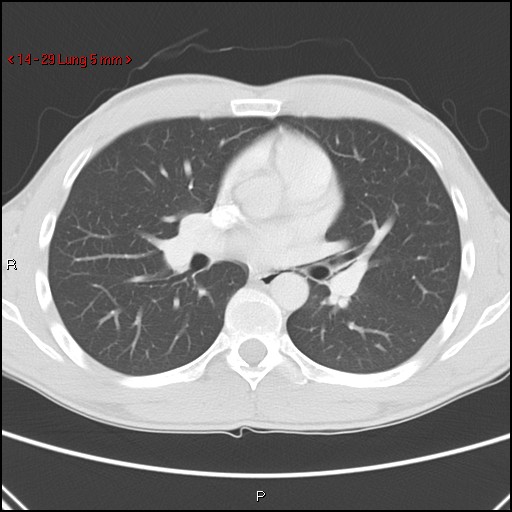 Blunt chest trauma - pulmonary interstitial emphysema and pneumomediastinum (Radiopaedia 20666-20552 Axial lung window 29).jpg