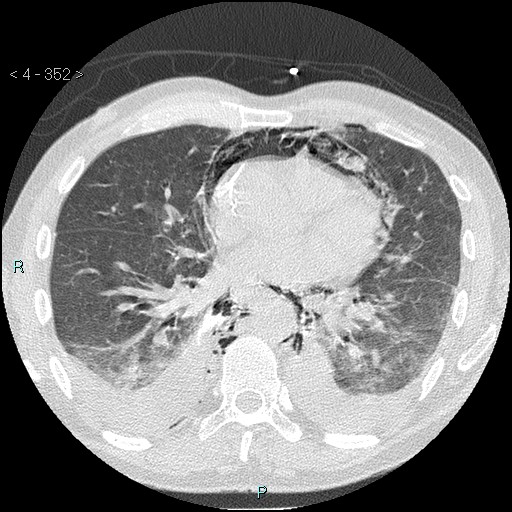 Boerhaave syndrome (Radiopaedia 27683-27897 lung window 52).jpg
