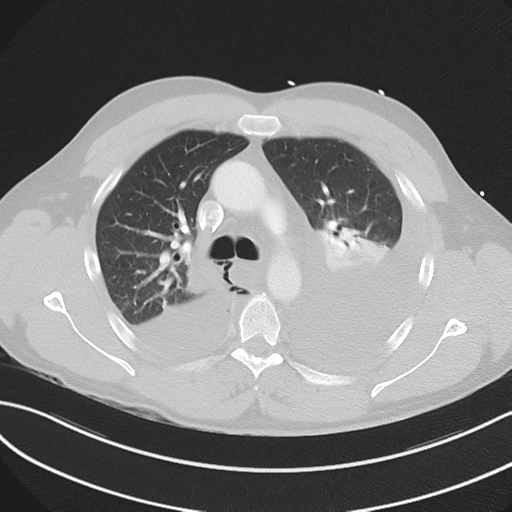 Boerhaave syndrome (Radiopaedia 39382-41660 Axial lung window 20).png