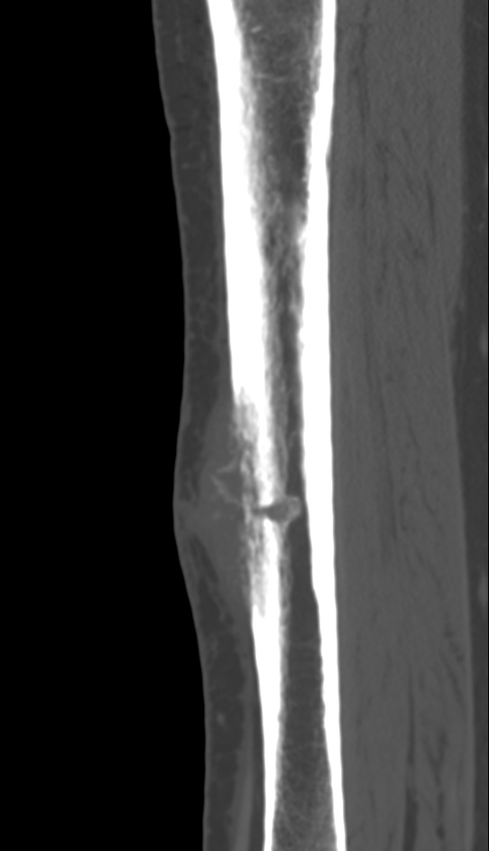 Bone metastasis - tibia (Radiopaedia 57665-64609 Sagittal bone window 90).jpg