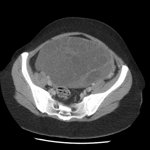 File:Borderline mucinous tumor (ovary) (Radiopaedia 78228-90808 A 118).jpg
