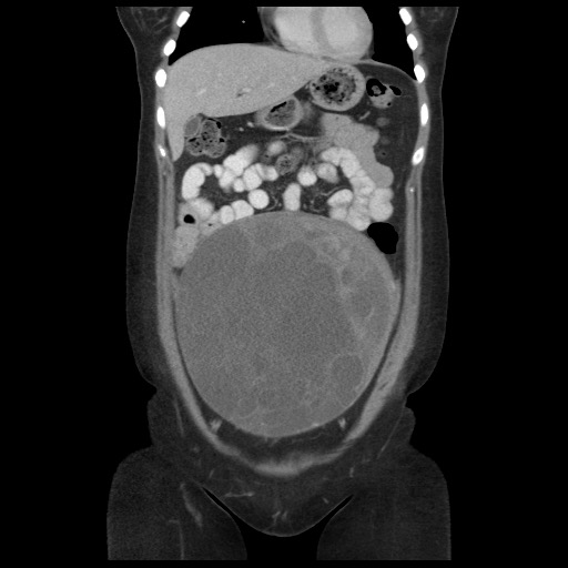 Borderline mucinous tumor (ovary) (Radiopaedia 78228-90808 C 17).jpg