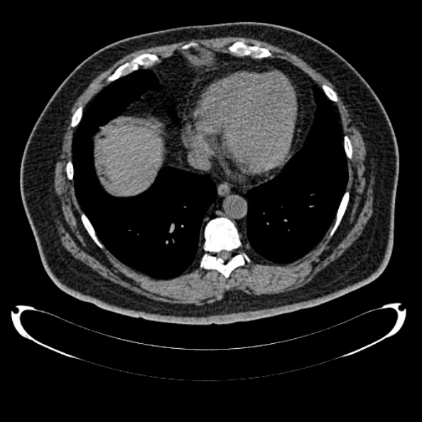 File:Bosniak renal cyst - type IV (Radiopaedia 24244-24518 Axial non-contrast 12).jpg