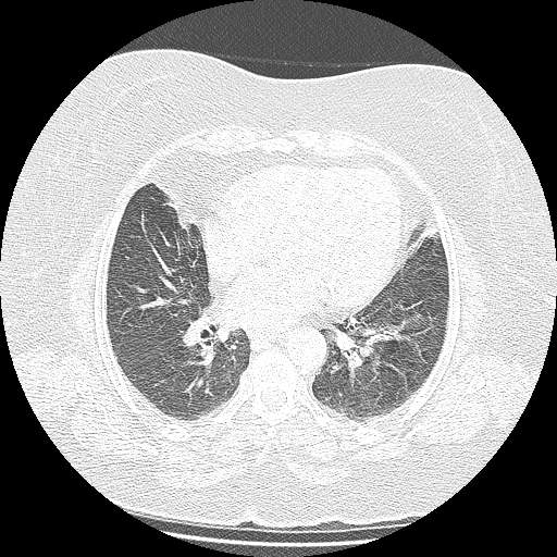 Bovine aortic arch - right internal mammary vein drains into the superior vena cava (Radiopaedia 63296-71875 Axial lung window 98).jpg