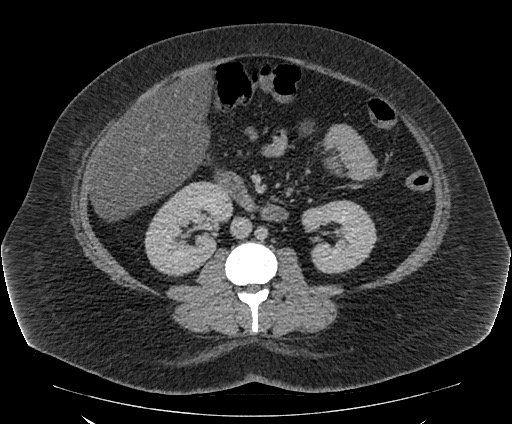 Bowel and splenic infarcts in acute lymphocytic leukemia (Radiopaedia 61055-68913 A 65).jpg