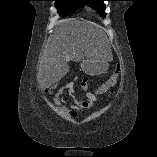 Bowel and splenic infarcts in acute lymphocytic leukemia (Radiopaedia 61055-68913 B 17).jpg