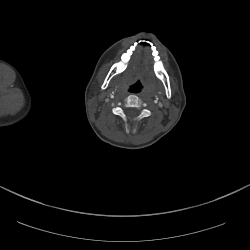 Brachiocephalic trunk pseudoaneurysm (Radiopaedia 70978-81191 Axial bone window 8).jpg