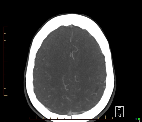 Brachiocephalic trunk stenosis (Radiopaedia 87242-103519 A 17).jpg
