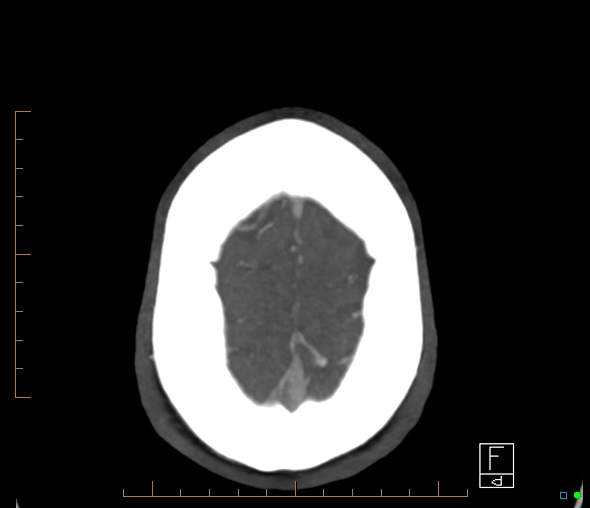 File:Brachiocephalic trunk stenosis (Radiopaedia 87242-103519 A 5).jpg