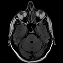 File:Brain abscess complicated by intraventricular rupture and ventriculitis (Radiopaedia 82434-96571 Axial FLAIR 6).jpg