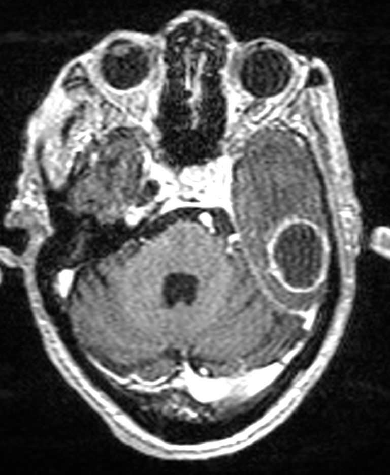 Brain abscess with dual rim sign (Radiopaedia 87566-103938 Axial T1 C+ 51).jpg