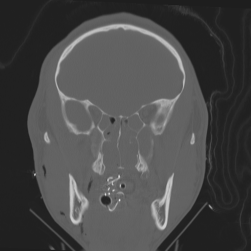 File:Brain contusions, internal carotid artery dissection and base of skull fracture (Radiopaedia 34089-35339 Coronal bone window 26).png