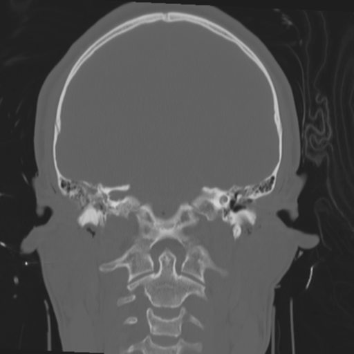 Brain contusions, internal carotid artery dissection and base of skull fracture (Radiopaedia 34089-35339 Coronal bone window 41).png