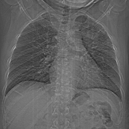 File:Brain metastases - lung cancer primary (Radiopaedia 75060-86116 Scanogram 1).jpg