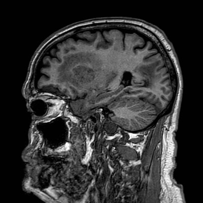Brain metastases from lung cancer (Radiopaedia 83839-99028 Sagittal T1 40).jpg