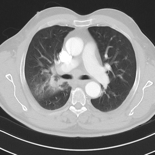 Brain metastasis (large cystic mass) (Radiopaedia 47497-52104 Axial lung window 19).png