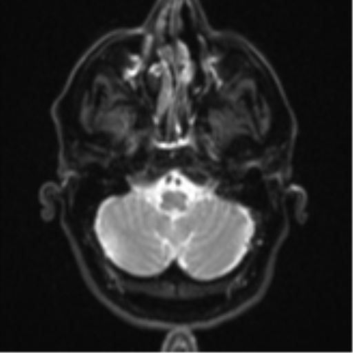 Brain metastasis (large cystic mass) (Radiopaedia 47497-52107 Axial DWI 4).png