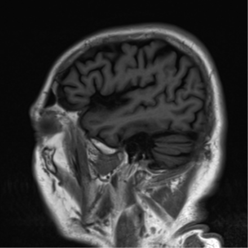 File:Brain metastasis (large cystic mass) (Radiopaedia 47497-52107 Sagittal T1 23).png