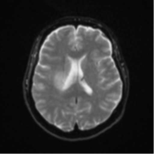 File:Brain metastasis (sarcoma) (Radiopaedia 47576-52209 Axial DWI 16).png