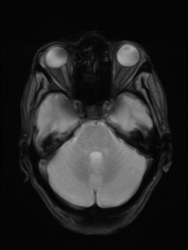 File:Brain metastasis as initial presentation of non-small cell lung cancer (Radiopaedia 65122-74126 Axial T2* 7).jpg