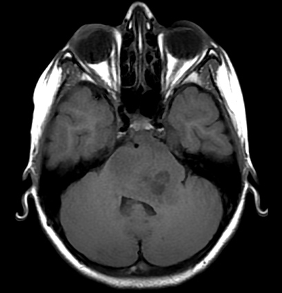 File:Brainstem glioma (Radiopaedia 9444-10124 Axial T1 1).jpg