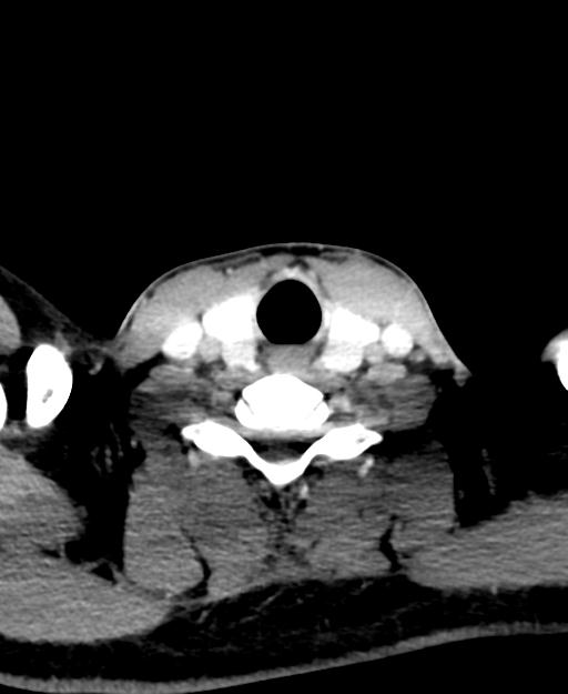 Branchial cleft cyst (Radiopaedia 31167-31875 Axial C+ delayed 50).jpg