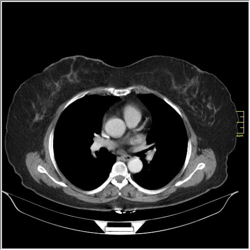 Breast cancer on thorax CT (Radiopaedia 60571-68275 A 49).JPG