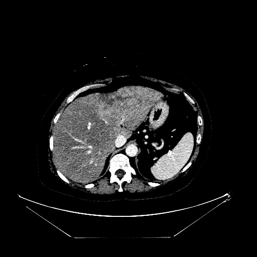 File:Breast cancer pseudocirrhosis with lobar invovlement (Radiopaedia 81080-94670 Axial liver window 42).jpg