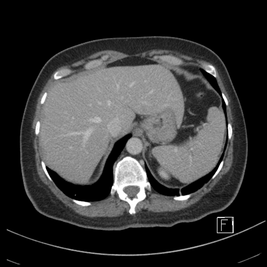 Breast metastases from renal cell cancer (Radiopaedia 79220-92225 C 15).jpg
